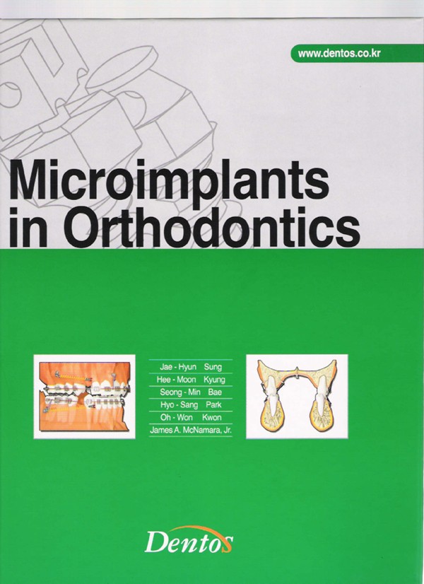 Microimplants in orthodontics