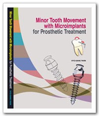 Minor tooth movement with Microimplants for prosthetic treatment
